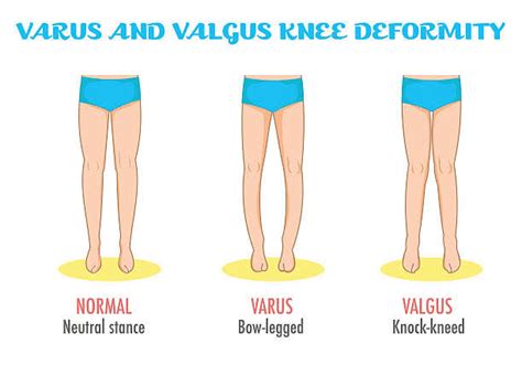 Rickets Causes Symptoms And Treatment Yoga Karlo
