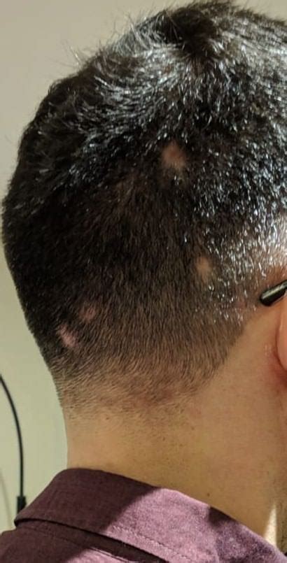 Pimples On Scalp Causing Bald Spots What Do Rhaircarescience