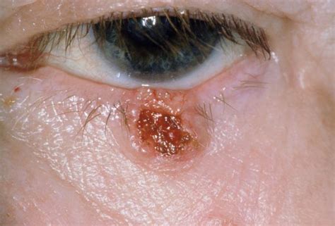 Image Basal Cell Carcinoma Of Eyelid Msd Manual Professional Edition