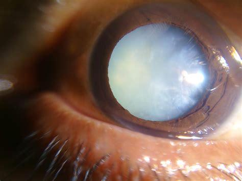 Everett And Hurite Ophthalmic Association Cataract Surgery Can Extend A