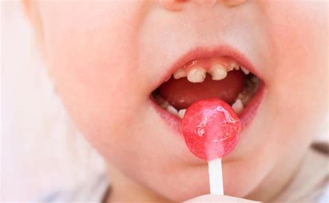 ¿qué Es La Caries Del Biberón Salud Dental Infantil • Bqdc