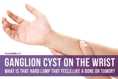 A tumor develops when cells reproduce too quickly. Ganglion Cyst On The Wrist: What Is That Hard Lump That ...