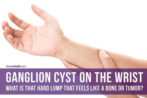 Hard, painful lump with a high temperature. Ganglion Cyst On The Wrist: What Is That Hard Lump That ...