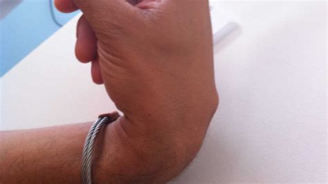 The calcaneus (heel bone) forms the back of your foot. Carpal Boss: Symptoms, Causes, Diagnosis, and Treatment