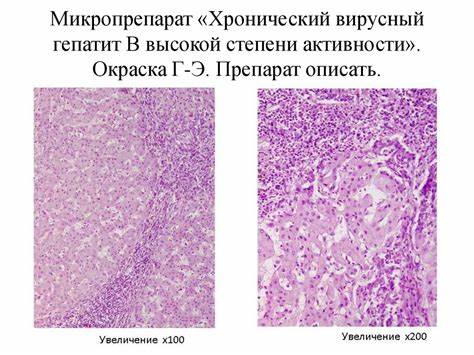 Хронический вирусный гепатит в диета Реакции гиперчувствительности. Аутоиммунные процессы. Амилоидоз Реакции гиперчувствительности. Аутоиммунные процессы. Амилоидоз Хронический вирусный гепатит в диета