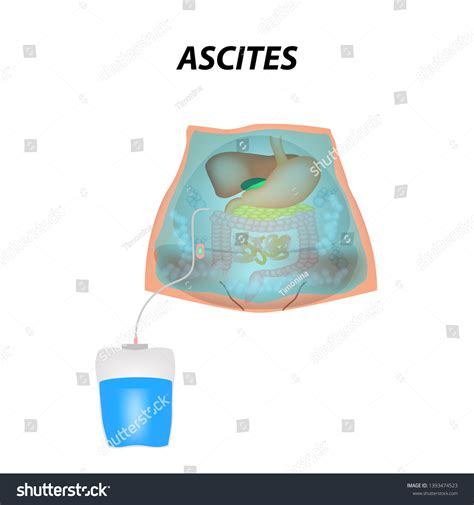 Ascites Free Fluid Abdominal Cavity Infographics Stock Illustration