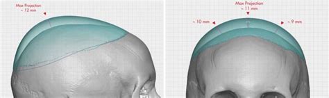 Plastic Surgery Case Study Custom Skull Implants For Crown