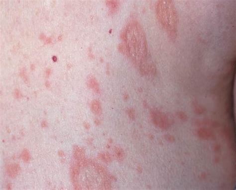 Pityriasis Rosea Causes Rash Herald Patch Stages Treatment Sexiz Pix