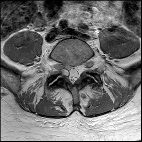 Mri Synovial Cyst Thoracic Spine Hot Sex Picture