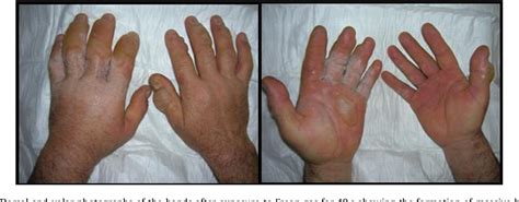 Figure 1 From Unusual Both Hands Cryogenic Burn Caused By Freon Gas And