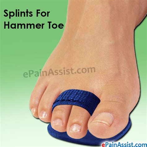 Hammer Toe Treatment Without Surgerysplintsshoespads