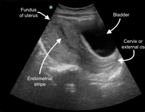 How To Perform And Interpret A First Trimester Transabdominal Point Of