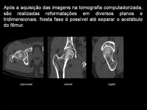 Tomografia Computadorizada O Quadril Especialista Em Cirurgia Do