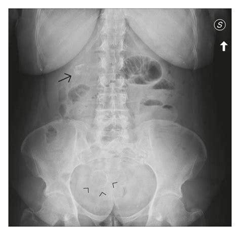 Upright Abdominal Radiograph Shows The Incomplete Manifestation Of The