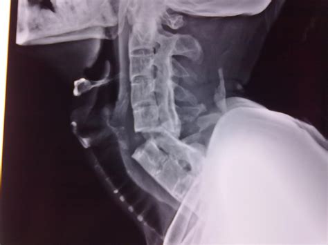 Dr K K Choudhary Spinal Fracture Total Disconnection Of Spinal Column