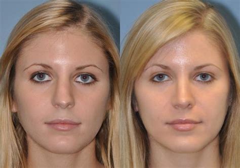 Revision Rhinoplasty Photos Chevy Chase Md Patient 8895