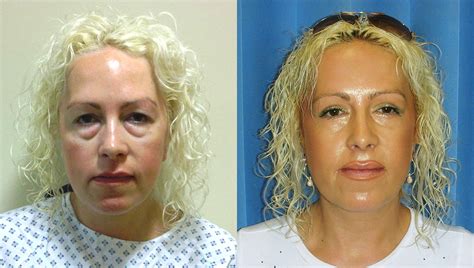 Eyelid Surgery Recovery Photos Eyelid Surgery Cost