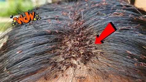 Omg Thousand Big Lice On Lady Head Lice Removal Youtube