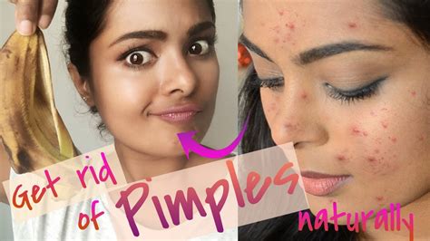 How To Get Rid Of Pimples Overnightreally Works Treat Acne At Home