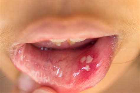 Dann geben experten für herpes genitalis eine dauer von durchschnittlich zehn tagen an. Aphten • Das hilft gegen schmerzhafte Bläschen!