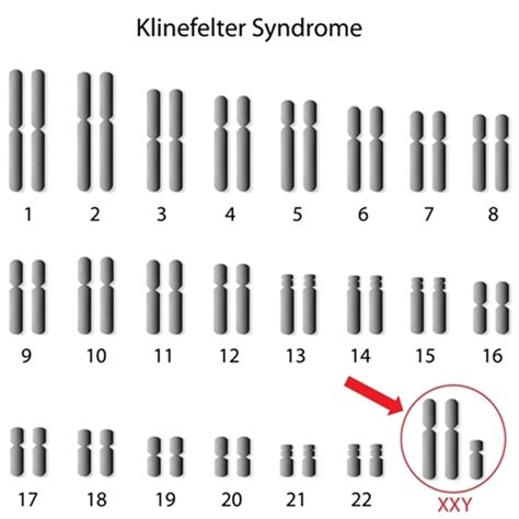 Cariotipo Sindrome De Klinefelter