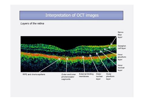 İnterpretation Of Optic Coherence Tomography Images