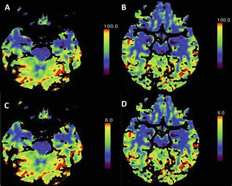 Ancillary Imaging Tests For Confirmation Of Brain Death Intechopen