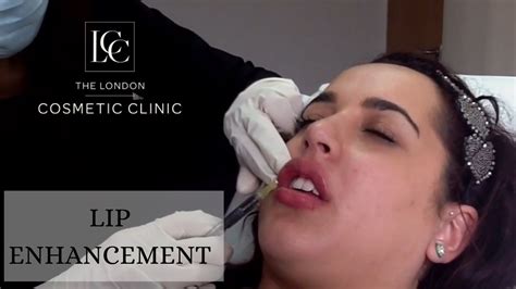 Lip Enhancement Dermal Filler Treatment Youtube