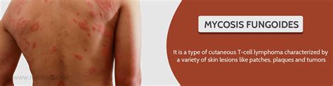 Mycosis Fungoides Causes Symptoms Diagnosis And Treatment