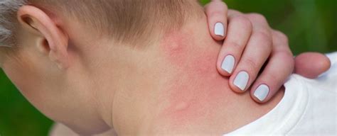 Mosquito Bites And Tips Ehrlich Pest Control