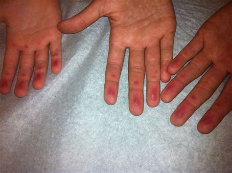 Mysterious Finger Rash Solved Pediatrics Solving Finger