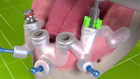 Straumann® Velodrill System For Blx Guided Surgery Youtube
