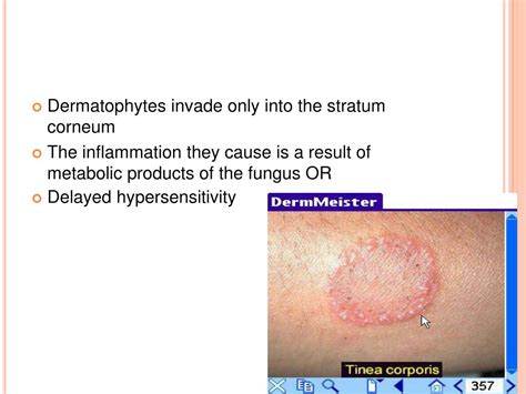 Ppt Fungal Infections Dermatophytic Infections Ringworm Powerpoint