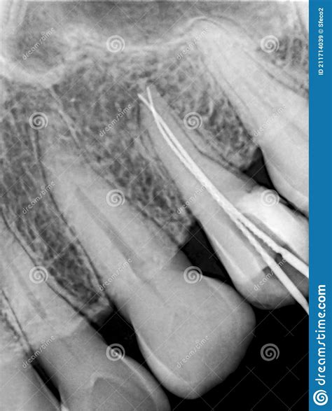 Close Up Low Resolution X Ray Image Of Human Canine Teeth Stock Image