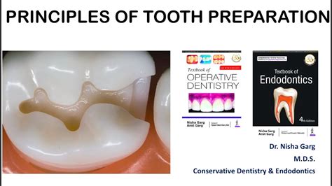 Principles Of Tooth Preparation Line And Point Angles Made Easy