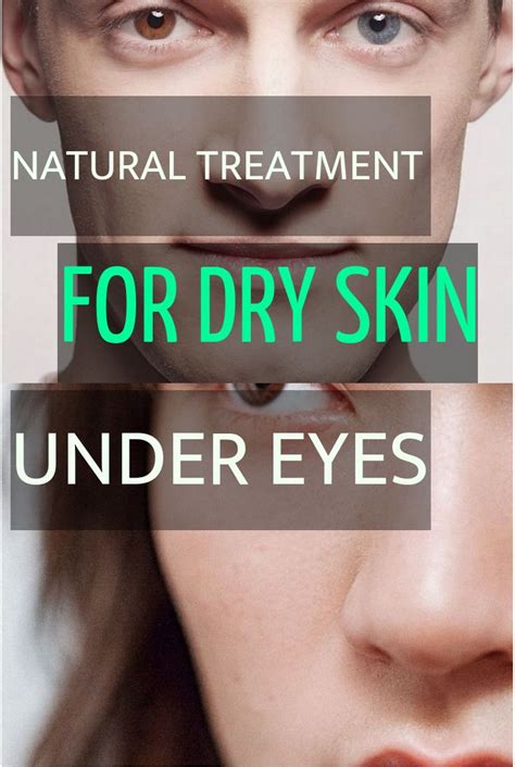 Ways To Get Rid Of Wrinkles Naturally Dry Skin Treatment Dry Skin