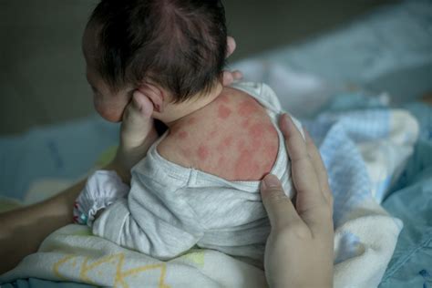 Common Rash In Newborn Usually Between 2 5 Day After Birth Erythema
