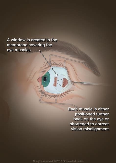 Eye Muscle Surgery