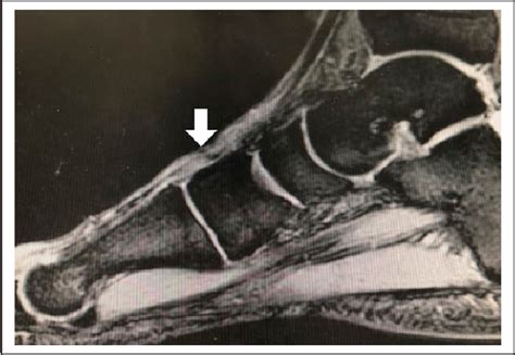 Figure From Chronic Extensor Hallucis Longus Tendon Rupture Treated With Double Bundle