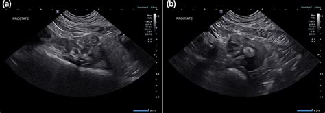 Ultrasound Images Of The Prostate In Sagittal A And Transverse B