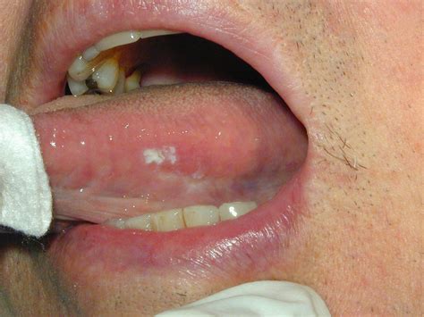 Oral Cancer Lesions Submited Images Pic2fly