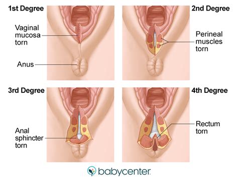 Everything You Need To Know About Perineal Tearing During