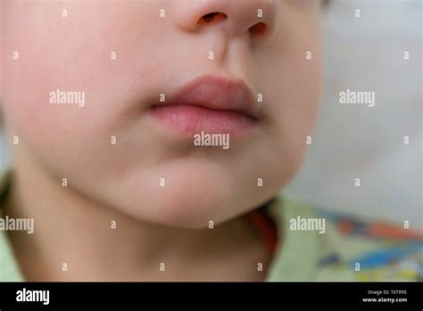 Close Up Of A Child With Toothache Swollen Cheek Gangrene Problems