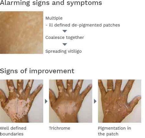Vitiligo Symptoms Symptoms Of Vitiligo Dr Batras™