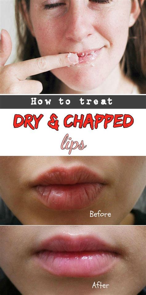 How To Treat Dry And Chapped Lips Beautytutorial Org Chapped Lips