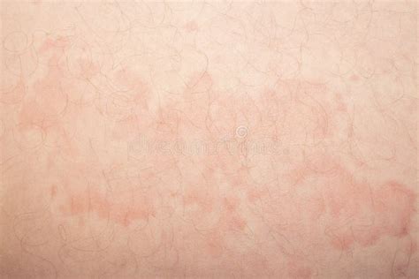 Skin Disease Urticariaskin Red Spots And Itching Stock Image Image
