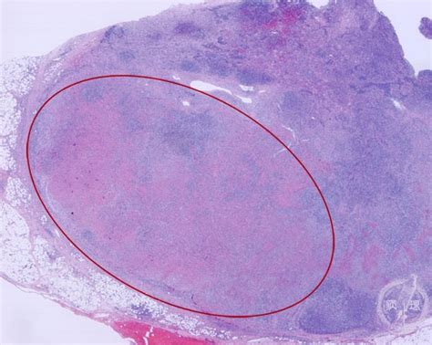 2lymph Node 1 Histiocytic Necrotizing Lymphadenitispathology Core