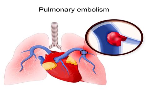 What Is Pulmonary Embolism Symptoms Risks Treatment
