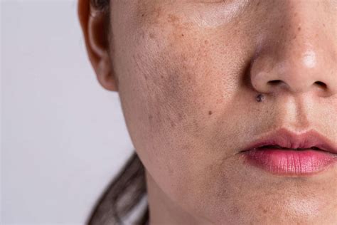Your Guide To Melasma Symptoms Causes And Treatment