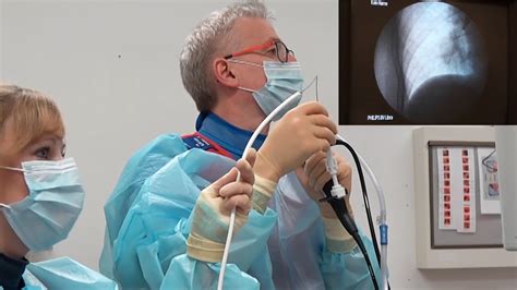 Transbronchial Cryobiopsies Using The Mm Single Use Probe With Oversheath Medical Videos